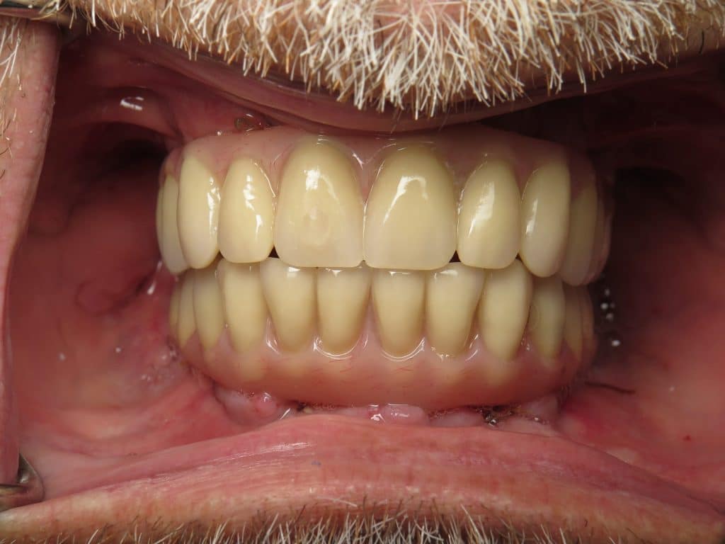 Implants next day with stitches