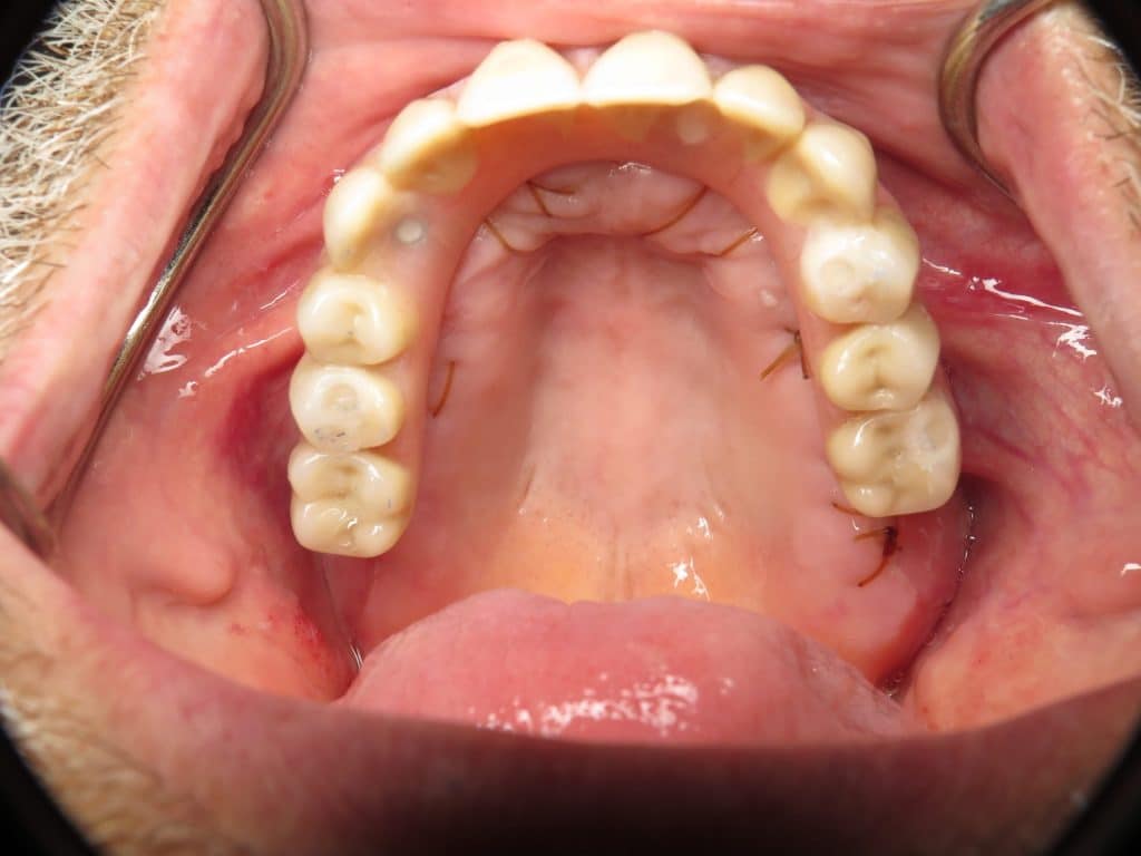 Upper implants next day