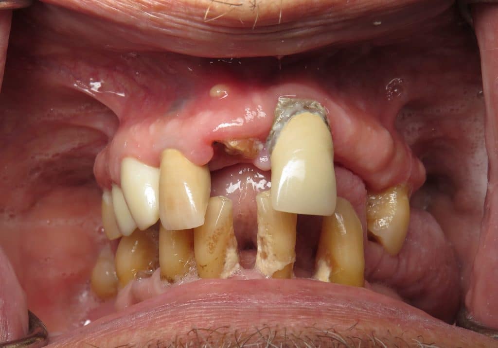 Preoperative dental condition