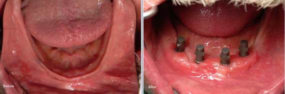 Burbank-Dental-Implants-Before-After-Bone-Graft-1