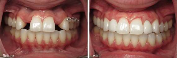 Burbank-Dental-Implants-Before-After-Bone-Graft-2