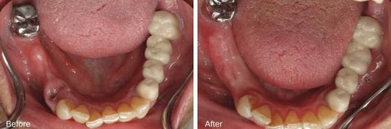 Burbank-Dental-Implants-Before-After-Bone-Graft-3