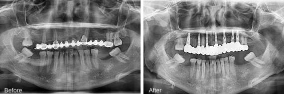 Burbank-Dental-Implants-Before-After-Bone-Graft-4