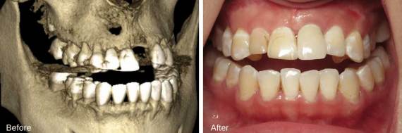 Burbank-Dental-Implants-Before-After-Bone-Graft-5
