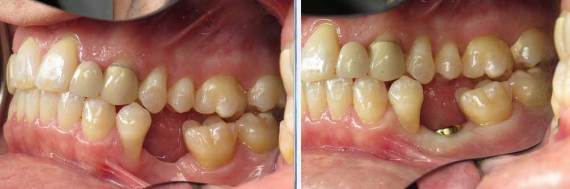 Burbank-Dental-Implants-Before-After-Bone-Graft-6