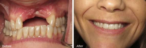 Burbank-Dental-Implants-Before-After-Failing-Implants-1