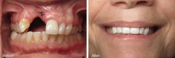 Burbank-Dental-Implants-Before-After-Failing-Implants-2