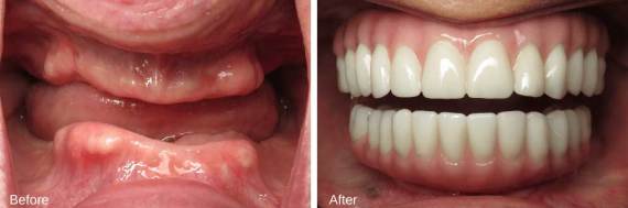 Burbank-Dental-Implants-Before-After-Failing-Implants-3