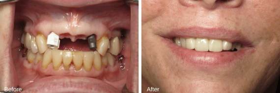 Burbank-Dental-Implants-Before-After-Failing-Implants-4