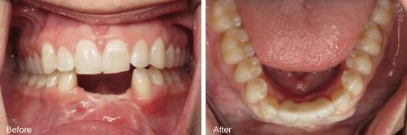 Burbank-Dental-Implants-Before-After-Failing-Implants-5