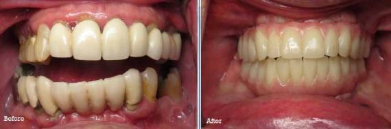 Burbank-Dental-Implants-Before-After-Failing-Implants-6