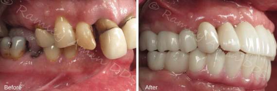 Burbank-Dental-Implants-Before-After-Full-Arch-1