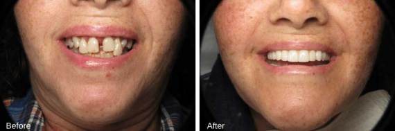 Burbank-Dental-Implants-Before-After-Full-Arch-2