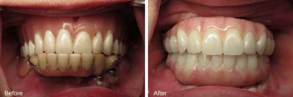 Burbank-Dental-Implants-Before-After-Full-Arch-3