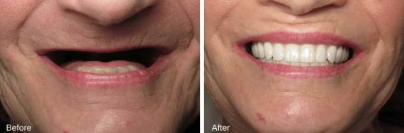 Burbank-Dental-Implants-Before-After-Full-Arch-4