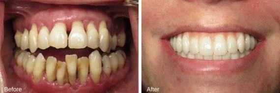 Burbank-Dental-Implants-Before-After-Full-Arch-5