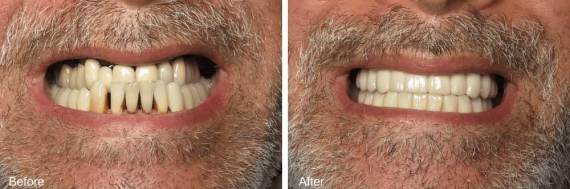 Burbank-Dental-Implants-Before-After-Full-Arch-6