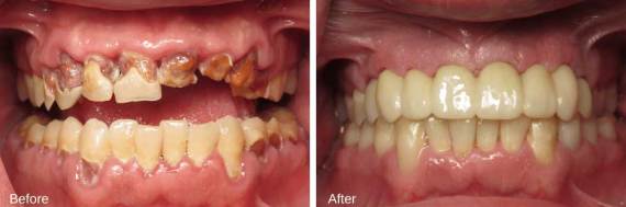 Burbank-Dental-Implants-Before-After-Multiple-Implants-1