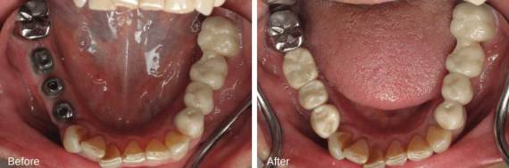 Burbank-Dental-Implants-Before-After-Multiple-Implants-2