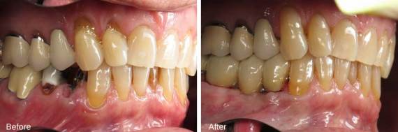 Burbank-Dental-Implants-Before-After-Multiple-Implants-3