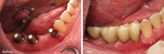 Burbank-Dental-Implants-Before-After-Multiple-Implants-4