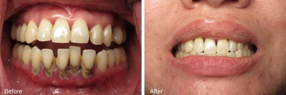 Burbank-Dental-Implants-Before-After-Multiple-Implants-5