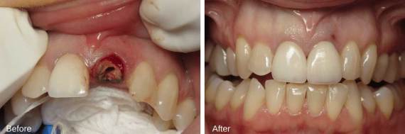 Burbank-Dental-Implants-Before-After-Single-Implant-1