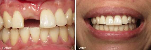 Burbank-Dental-Implants-Before-After-Single-Implant-2