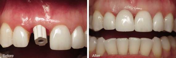 Burbank-Dental-Implants-Before-After-Single-Implant-3