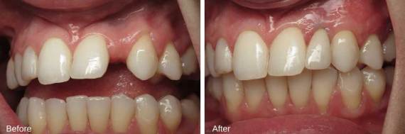 Burbank-Dental-Implants-Before-After-Single-Implant-4