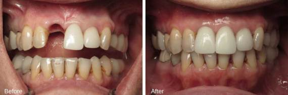 Burbank-Dental-Implants-Before-After-Single-Implant-5