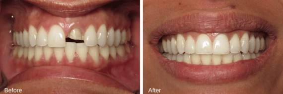 Burbank-Dental-Implants-Before-After-Single-Implant-6