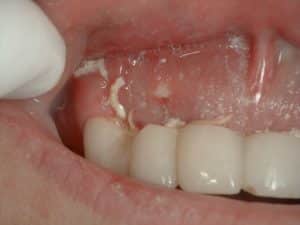 Bone Is Showing After Tooth Extraction Graft Ramsey Amin Dds Helps