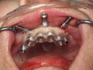 burbank dental implant guided