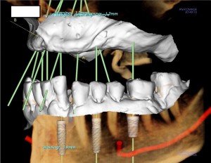 computer guided dental implant surgery