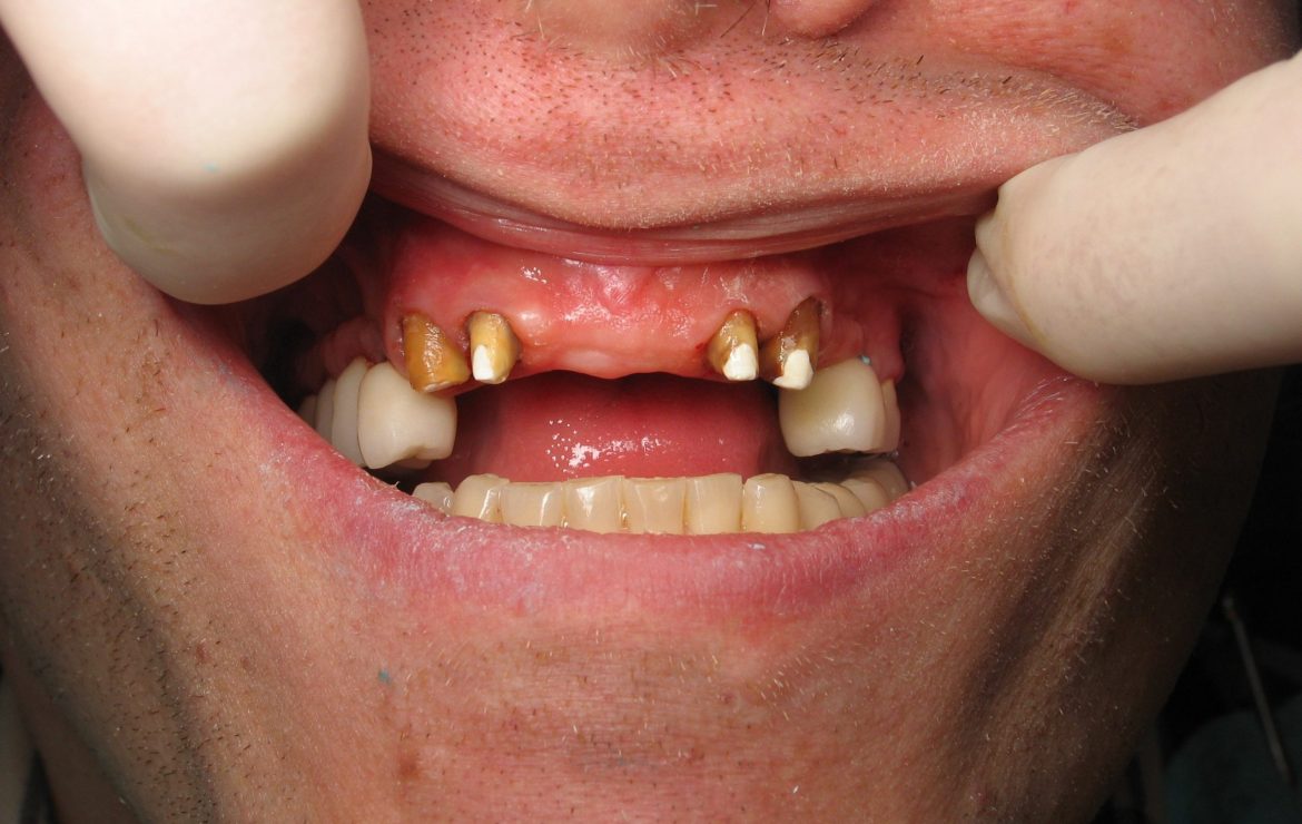 Dental Implants…Why not have a bridge instead?