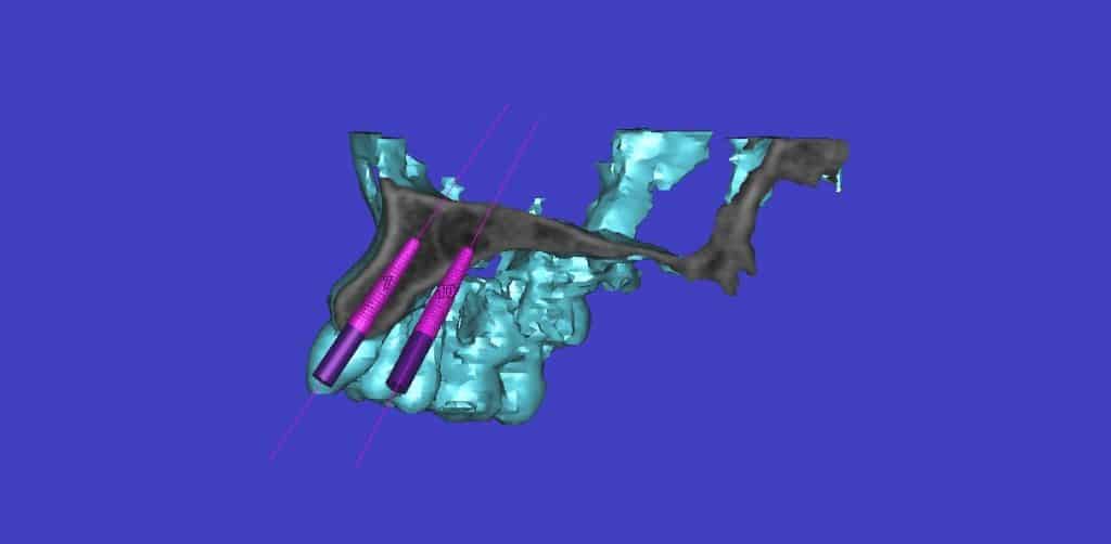 3D scan of placement for implants