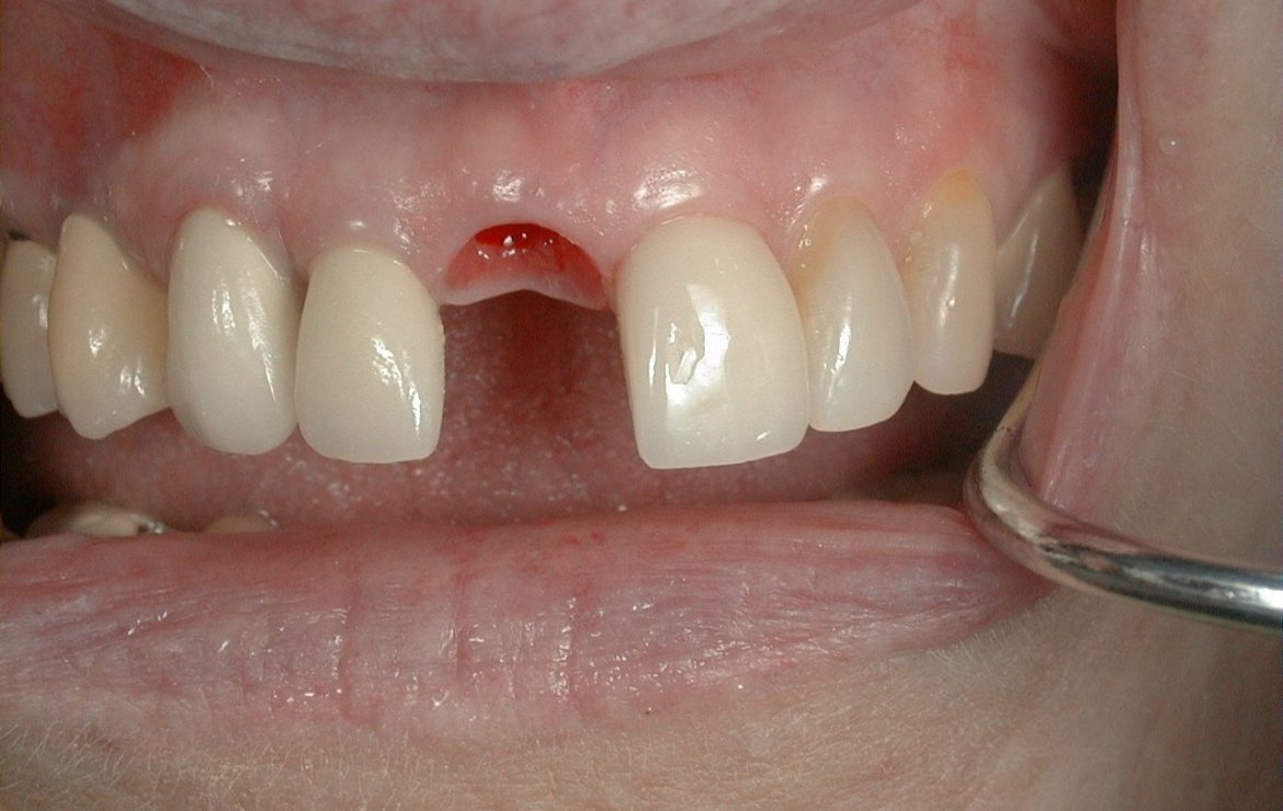 Front Teeth Dental Implant Samples
