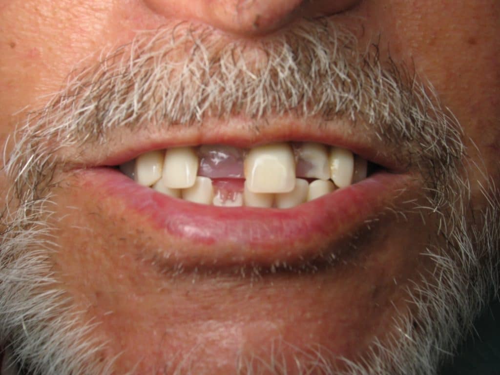 Missing enamel on teeth
