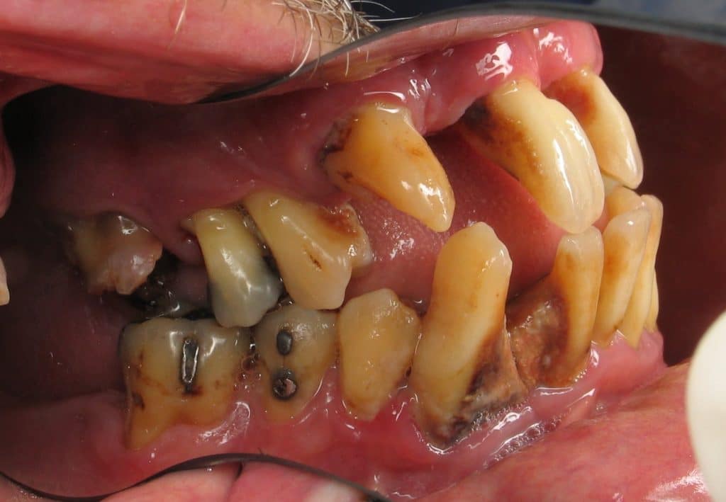 Bad teeth with bone loss and decay