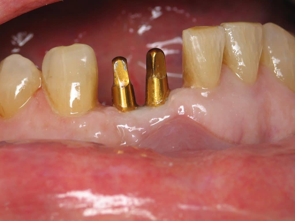 Two Lower Front Teeth Dental Implants