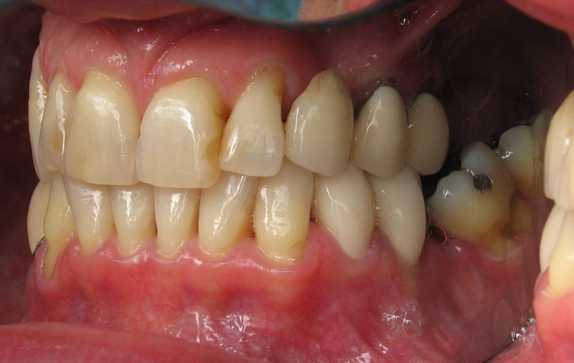 Orthodontic Dental Implants…They Help With Braces Too!