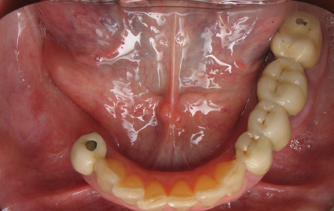 Dental Implant Case Example For Back Teeth