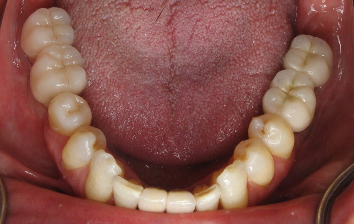 Do I Need Custom Dental Implant Abutments?
