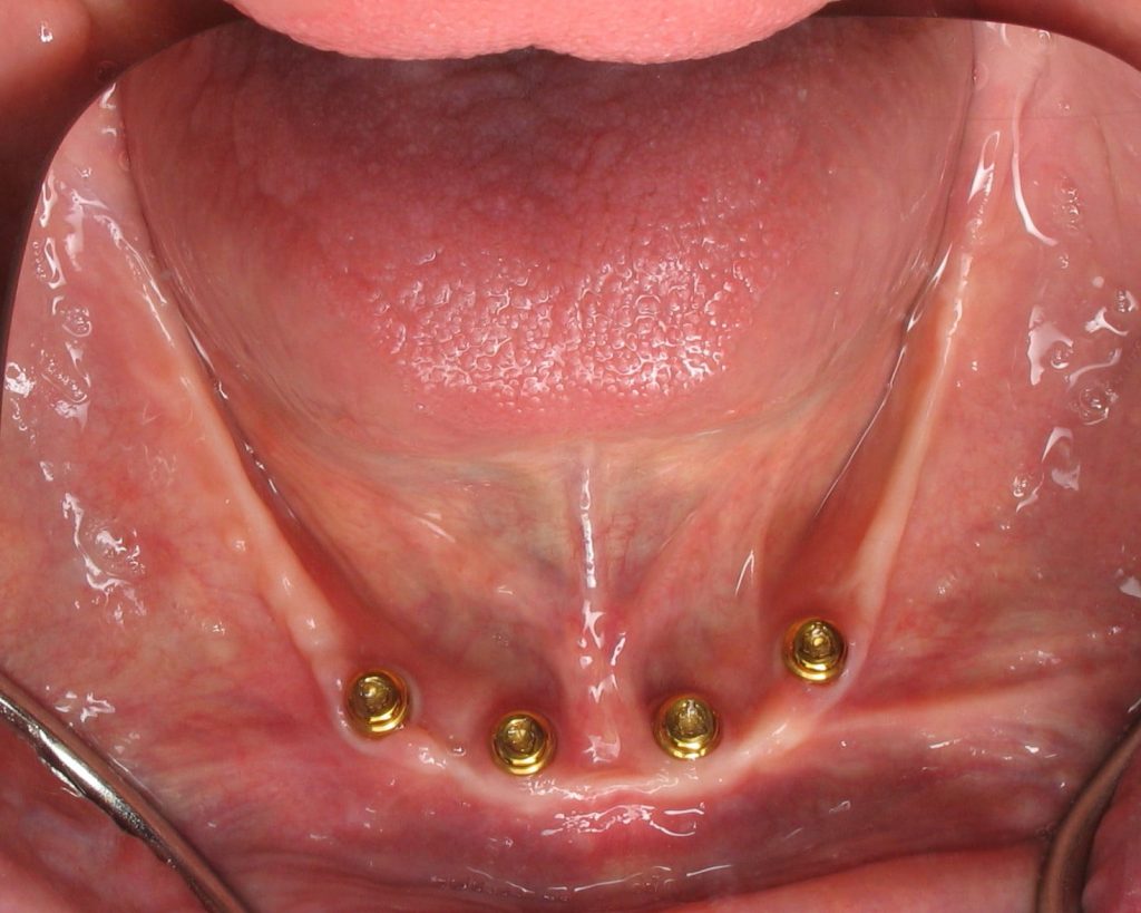 lower overdenture abutments LOCATOR