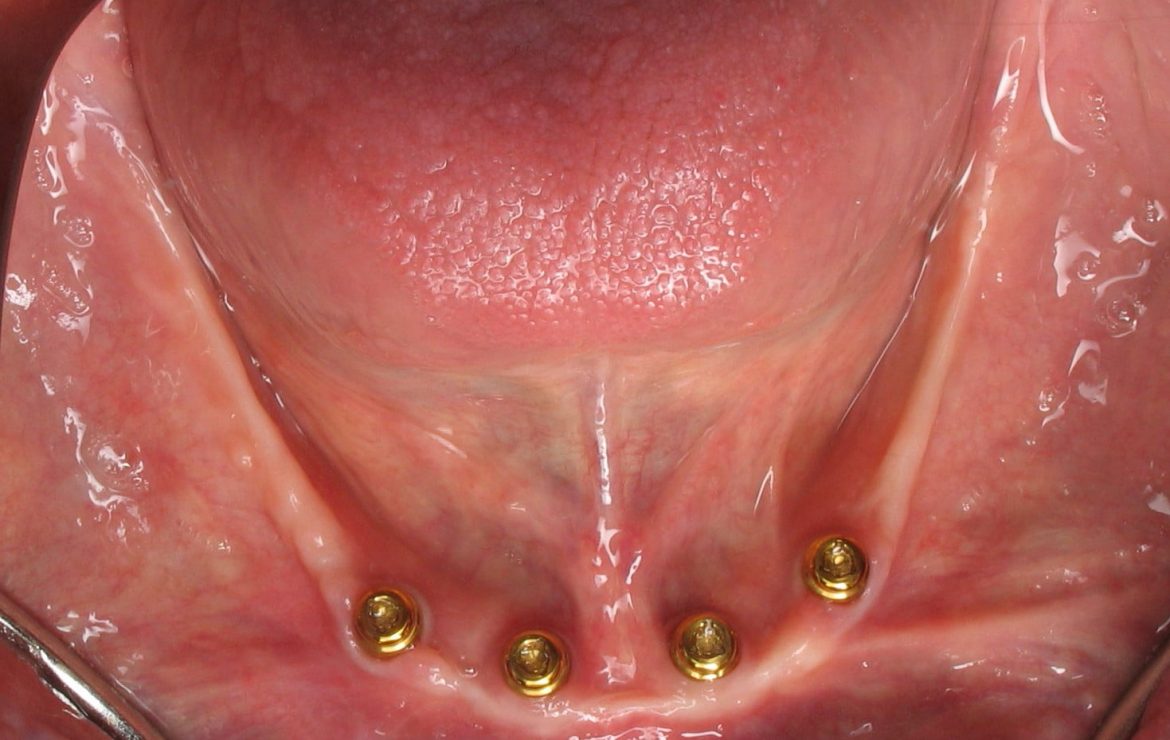 Dental Implant CT Scan Video