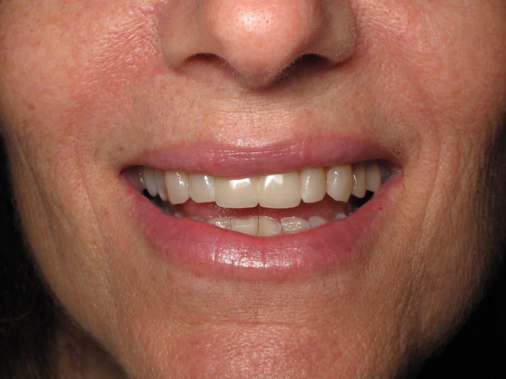 Front Tooth Bone Loss and Dental Implant Replacement