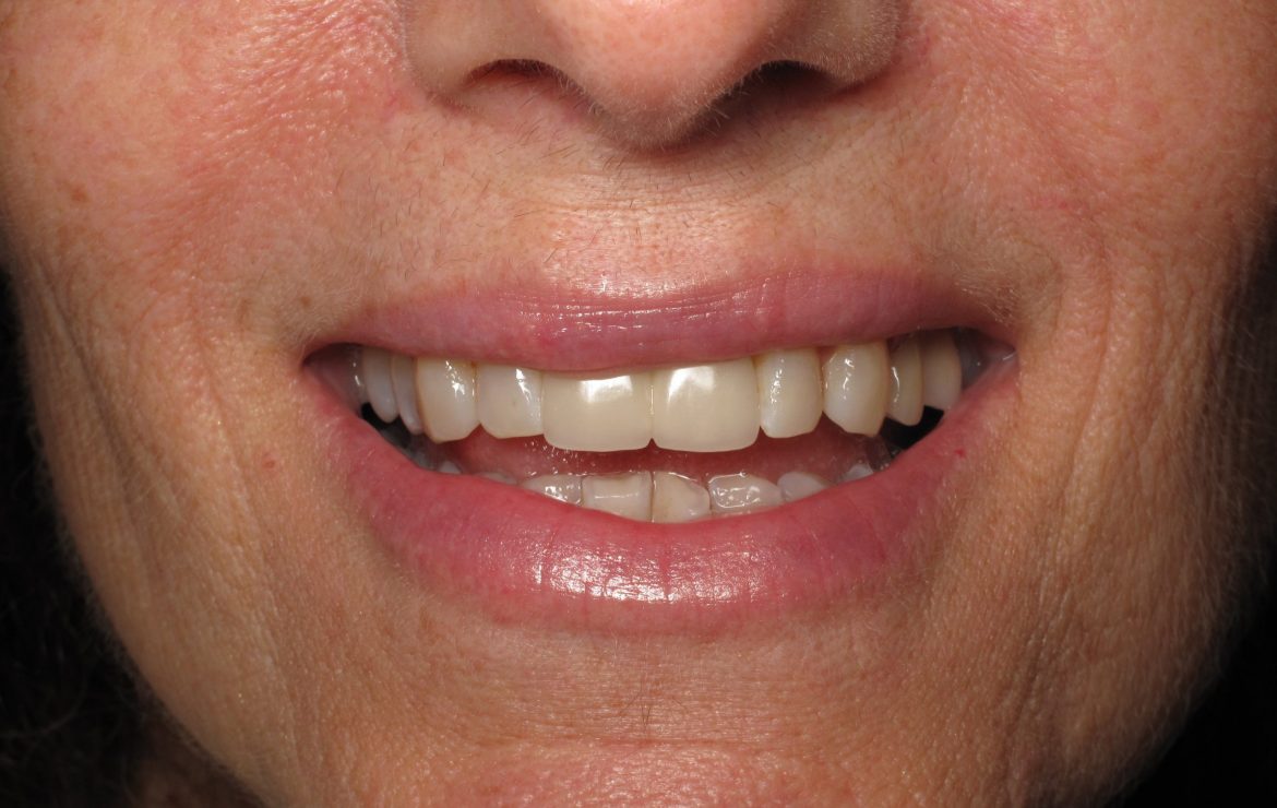 Front Tooth Bone Loss and Dental Implant Replacement
