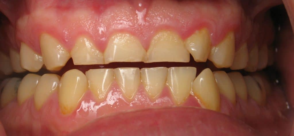 Flattened down teeth