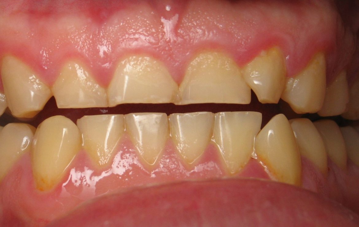 Dr. Oz Reveals The Devastating Consequences of Teeth Grinding